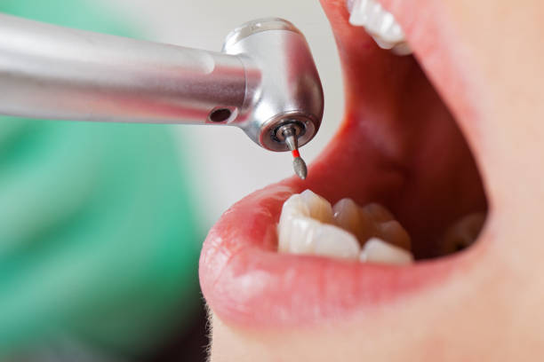 Best Root Canal Emergency Dentist  in Tornillo, TX